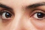 eye-bags