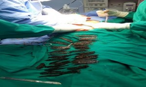 一印度男子胃中藏40把刀，术后奇迹恢复！