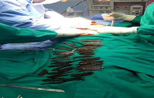 一印度男子胃中藏40把刀,术后奇迹恢复! 一印度男子胃中藏40把刀,术后奇迹恢复!