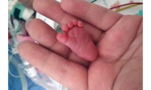 Caesarean相关阅读