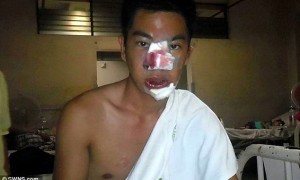 男模花71元给鼻子做整形彻底毁容 工作只能扮鬼