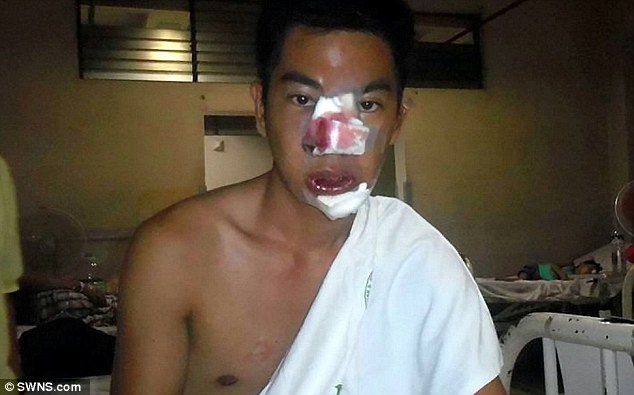 男模花71元给鼻子做整形彻底毁容 工作只能扮鬼 男模花71元给鼻子做整形彻底毁容 工作只能扮鬼