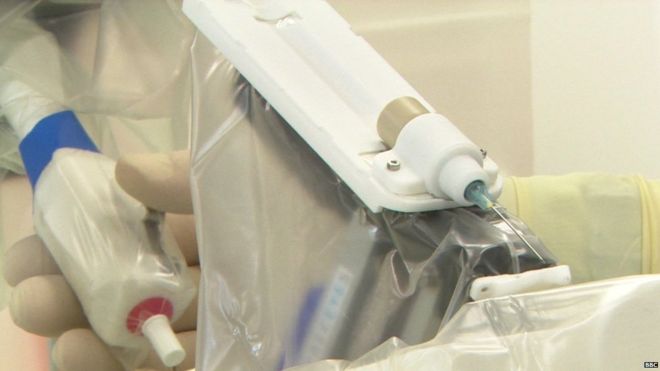 全球首例机器人眼内操作手术成功 全球首例机器人眼内操作手术成功
