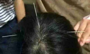 needles相关阅读