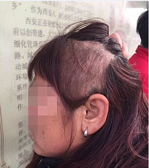 女子公交车上大声打电话遭殴打 半边头发被拽掉 女子公交车上大声打电话遭殴打 半边头发被拽掉